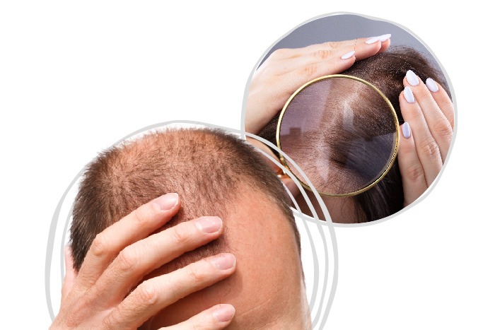 hair loss management